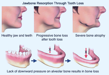 What Is A Bone Graft And Why Do I Need It? | Scottsdale Dental Solutions